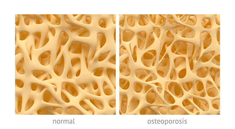 luun normaali rakenne ja rakenne osteoporoosissa